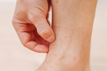 Close up man scratching with hand allergic rash on leg. Leg with red rash caused by insect bites....