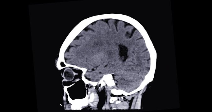 CT scan of the brain  sagittal view for diagnosis brain tumor,stroke diseases and vascular diseases.