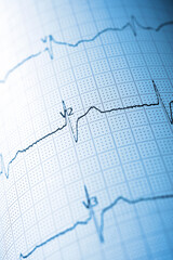 Close-up of an electrocardiogram printed on blue paper.