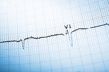 Close-up of an electrocardiogram printed on blue paper.