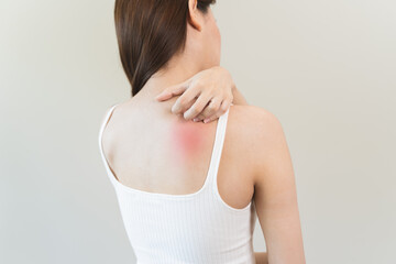 Fototapeta na wymiar Sensitive skin allergic concept, Woman itching on her back have a red rash from allergy symptom and from scratching.