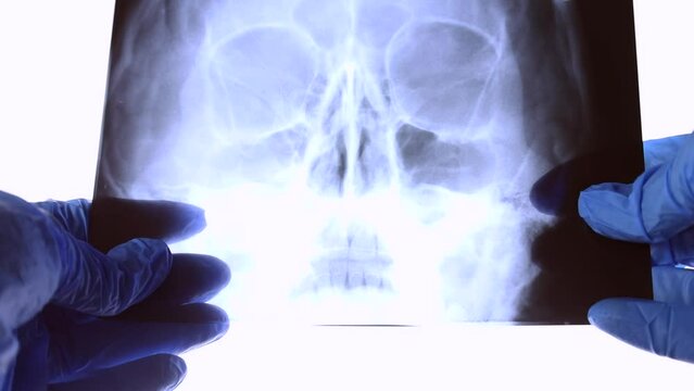 X ray scan of human skull in doctor hands. Ct head scanning on light background in a hospital. Medical research for desease or bones injury test