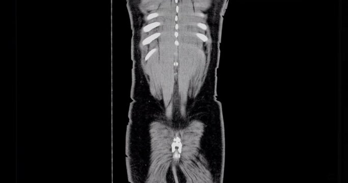 Computed tomography abdomen (CT SCAN)
