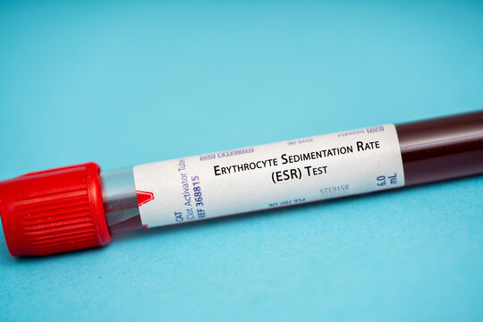 Erythrocyte Sedimentation Rate (ESR) Test