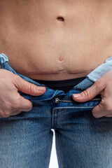 A woman in jeans shows a scar on her stomach. Consequences of caesarean section and operation on umbilical hernia. Vertical.