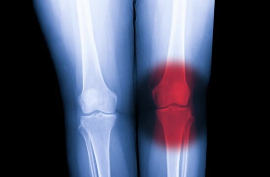 x-ray knee joint show OA knee and pain in joint