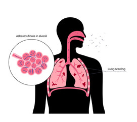 Asbestosis lung disease Generative AI