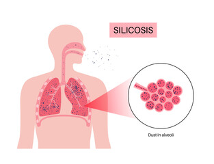 Silicosis dust in lung Generative AI - 598743489