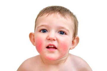 Portrait of a child with allergies on the cheeks and chin. Toddler baby boy with allergies on red face skin, white background