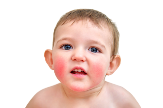Portrait of a child with allergies on the cheeks and chin. Toddler baby boy with allergies on red face skin, white background