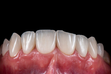 broken max veneers before replacing
