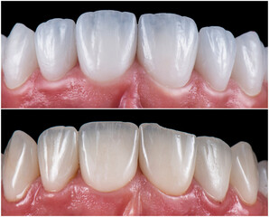max crowns and veneers