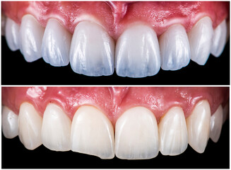 max crowns and veneers