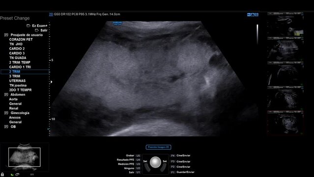 Ultrasound of a pregnant baby where his heart is observed beating, with the words of the ultrasound device system in Spanish
