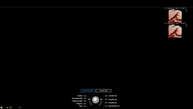 Ecografia de un bebe en gestacion donde se puede ver su rostro, con las palabras del sistema del aparato ecografo en espa&ntilde;ol