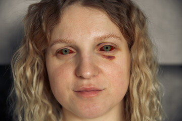 Portrait of a girl with red eyes. Eyes injury after difficult childbirth