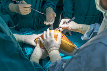 Doctor or orthopedic surgeon in green uniform holding medical scalpel or knife inside operating room.Hand with medical glove.People did total knee joint replacement surgery technology.Incision made. - obrazy, fototapety, plakaty