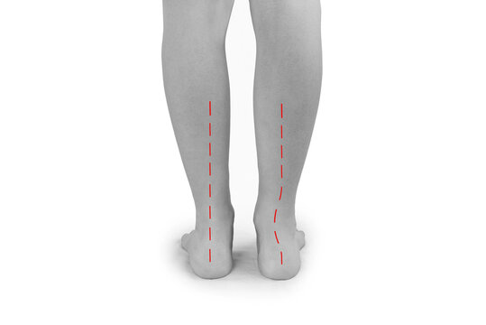 Feet of a teenager with flat feet or a dropped arch, with the ankle tilted inward. A line showing the abnormal shape of a flat foot compared to a normal foot.