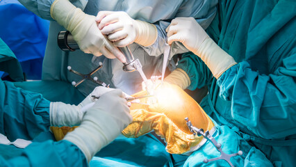 Doctor or surgeon in blue gown used robotic navigator total knee joint arthroplasty surgical instrument inside operating room.Medical technology in orthopedic surgery.Hand of people with a saw. - obrazy, fototapety, plakaty