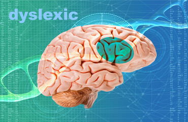 Neural Signature in human brain for Dyslexia, Disruption of Posterior Reading System, dyslexic, dna...