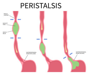Peristalsis medical anatomy swallow eating achalasia problem hypermotility with hyperperistalsis Gas distension Nausea Bloated Burping hypomotility hypoperistalsis pain