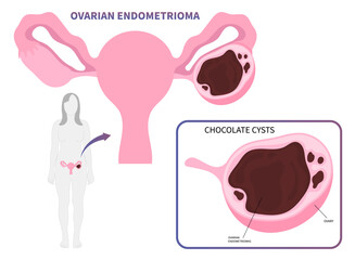 In Vitro Fertilization or IVF with chocolate cyst Ovarian Endometrioma cancer tumor endometriosis uterus Polycystic Ovary Syndrome - obrazy, fototapety, plakaty