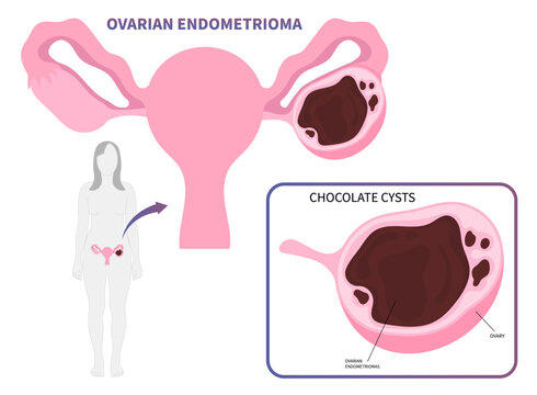 In Vitro Fertilization or IVF with chocolate cyst Ovarian Endometrioma cancer tumor endometriosis uterus Polycystic Ovary Syndrome