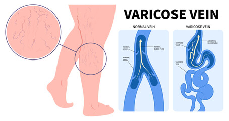 Cramps Limb Injury Phlebectomy of Vascular Artery Disease Medical Anatomy Varicose Vein or Endovenous Laser Venous and Valves Knee Heart Foot Calf Treat Flow Thigh Socks High Sores Aching