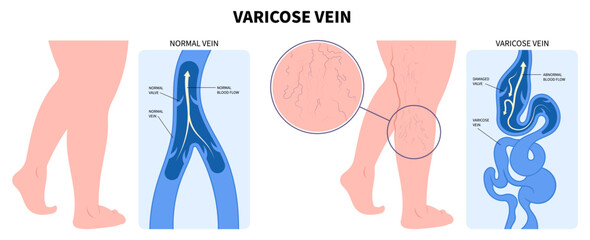 Artery Disease Medical Foot Calf Aching Injury Treat Varicose Vein or Phlebectomy Anatomy Endovenous Laser Vascular Venous and Knee Heart Flow Thigh Socks High Valves Cramps Limb Sores