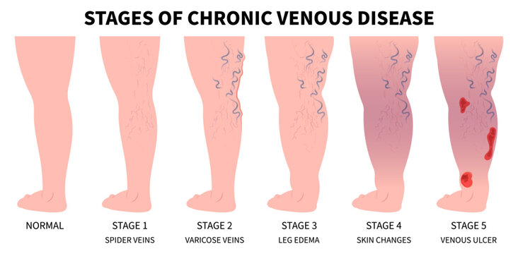 Vascular Artery Disease Medical Anatomy Varicose Vein Phlebectomy or Endovenous Laser Venous and Valves Cramps Limb Sores Aching Knee Heart Foot Calf Treat Flow Thigh Socks High Injury