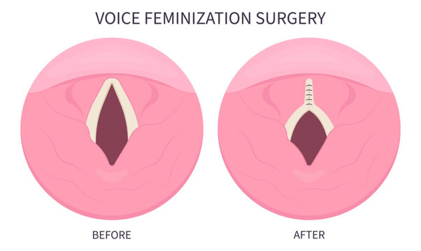 Voice Feminization Surgery male to female of Adam's procedure face speech estrogen exercise affirming care