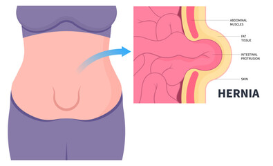 belly button umbilical hernia stomach abdominal pain small large intestine constipation or inguinal incisional Femoral diastasis recti ileus lump navel wall cavity baby infant birth volvulus Hiatus