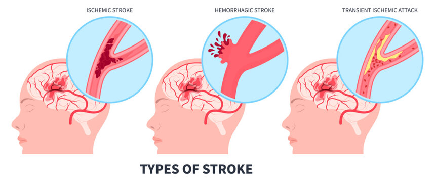 Brain attack damage frontal lobe of Stroke vascular dementia Hemorrhagic transient ischemic Alzheimer's heart pill mini risk signs symptom care Fatty deposits High and TIA arm face memory blockages