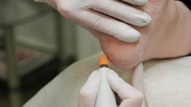 Removal of the hard keratinized layer from the heel skin using the grinding tool. Podology and pedicure. Foot care