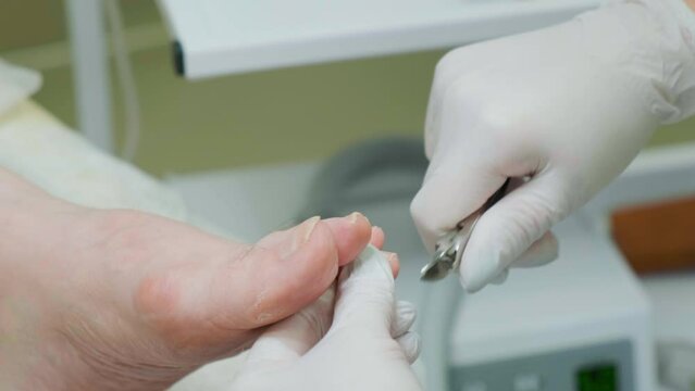 A pedicure master removes an ingrown toenail from a toe in the salon using forceps. Podology and foot health