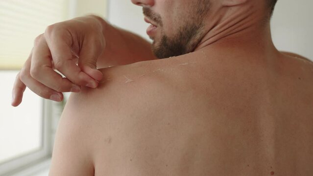 Dark man with beard is trying to remove peeling of skin on back. Guy removes desquamated thin pieces of dry epidermis. Concept of poor skin care, exposure to negative environmental factors in city.