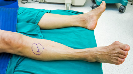 Check mark at right leg inpatient inside operating room.Hallux valgus or bunion surgery.Patient...
