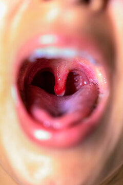 open wide mouth with swollen uvula showing inside