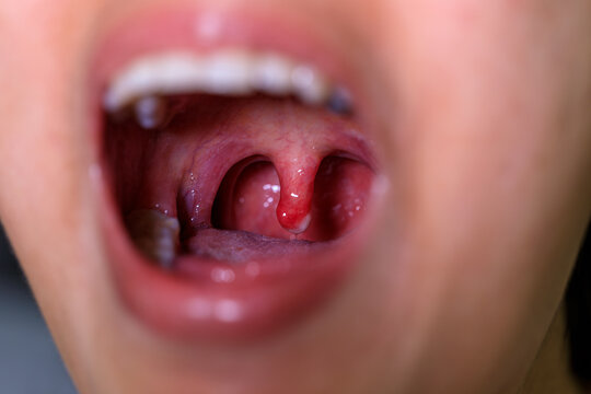 open wide mouth with swollen uvula showing inside