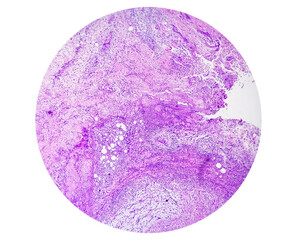 Photomicrograph of breast abscess, Granulomatous mastitis, show dense infiltration of polymorphs,...