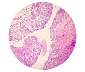 Photomicrograph of breast abscess, Granulomatous mastitis, show dense infiltration of polymorphs,...