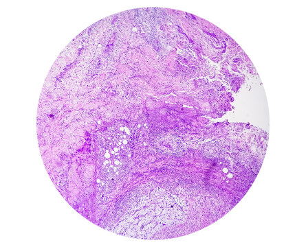 Photomicrograph of breast abscess, Granulomatous mastitis, show dense infiltration of polymorphs, lymphocytes, histiocyte, epithelioid cells, plasma cells, fibroblast.
