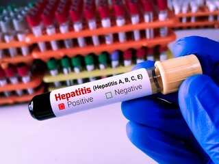 Scientist hold blood sample for Hepatitis virus (Hepatitis A, B, C, E) test.