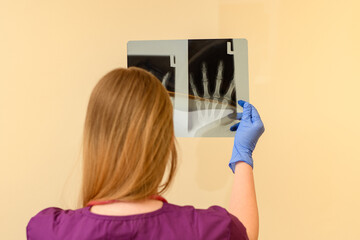 Pani doktor ortopeda trzymająca zdjęcie rentgenowskie dłoni  - obrazy, fototapety, plakaty