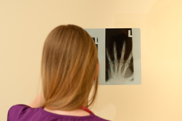pani doktor ortopeda ogląda zdjęcie rentgenowskie rtg, prześwietlenie dłoni  - obrazy, fototapety, plakaty