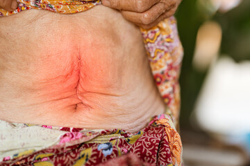 Abdominal surgery wounds of elderly patients with gastritis or abdominal disease.