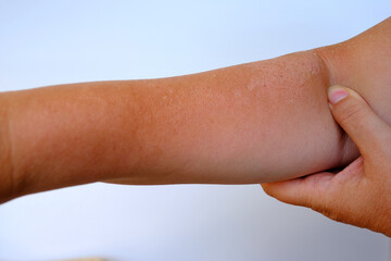 sunburn on skin, exfoliation of epithelium, severe peeling of the skin after sunburn, hands of an...
