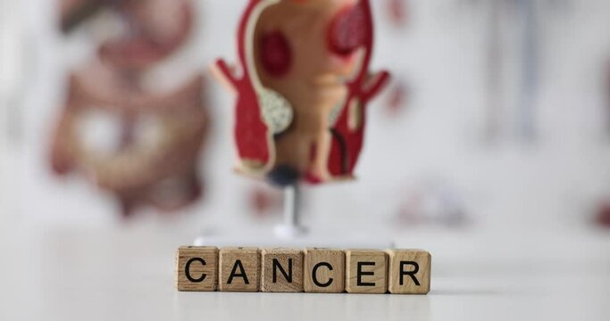 Word cancer on cubes on background of anatomical model of rectum. Colon cancer symptoms and treatment