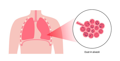 Pneumoconiosis lung disease