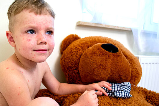 Natural vaccination. Contagious disease. Sick boy chickenpox with toy bear. Varicella virus or Chickenpox bubble rash on child body and face. High quality photo